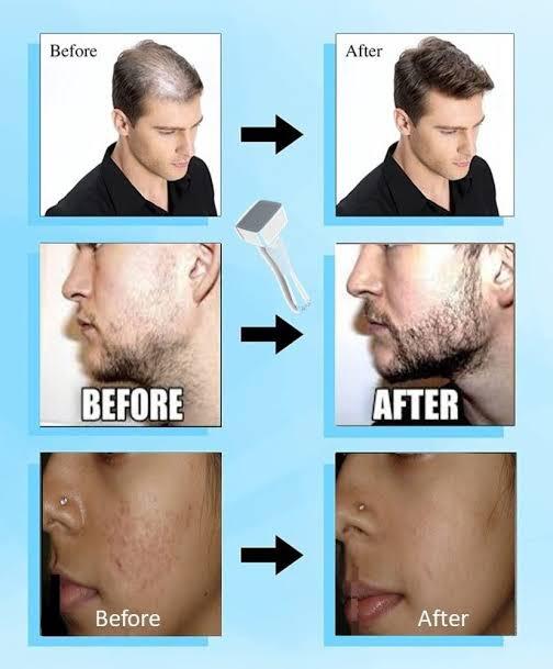 Derma Stamp Micro Needling Tool .